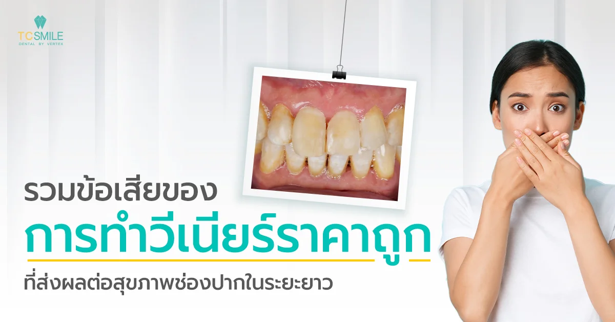 ทําวีเนียร์ราคาถูกมากดีจริงหรือ เปิดข้อเท็จจริงที่คุณควรรู้