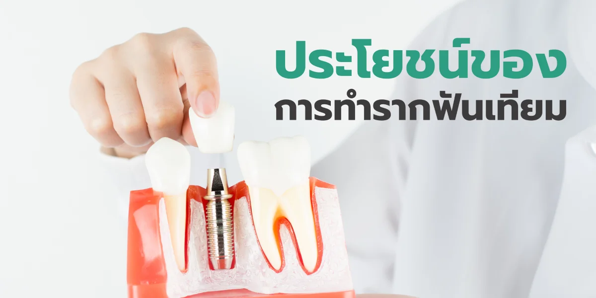 ประโยชน์ของการทำรากฟันเทียม
