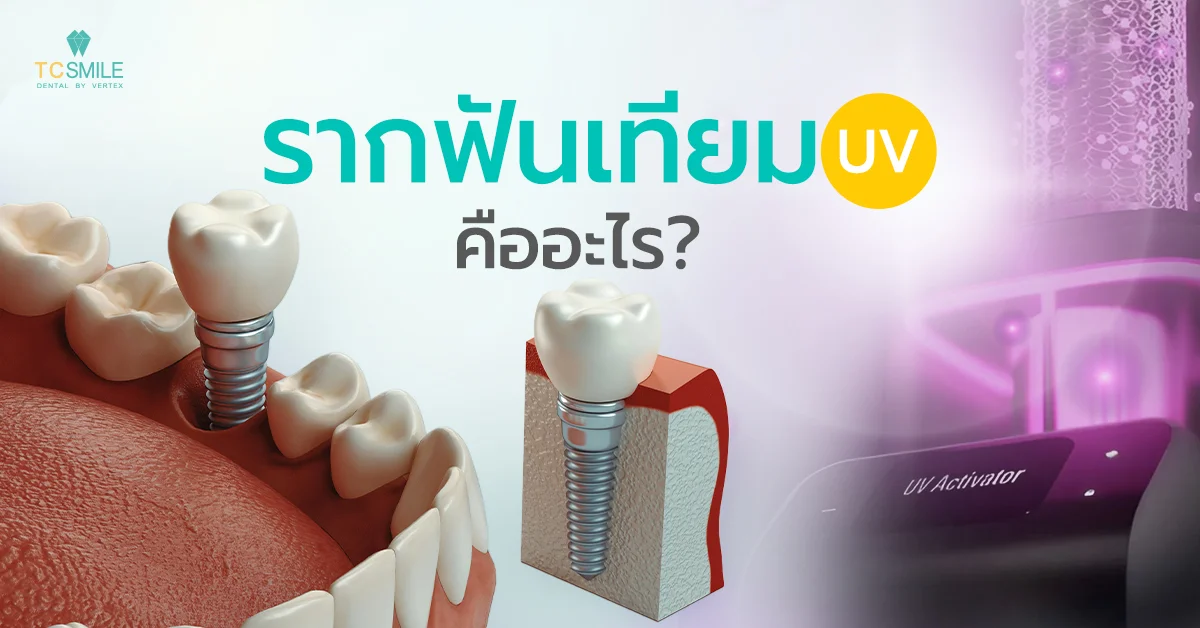 รากฟันเทียม UV คืออะไร