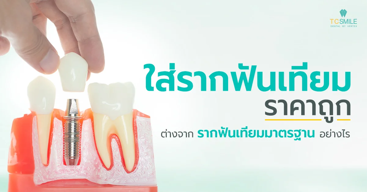 รากฟันเทียมราคาถูกต่างจากรากฟันเทียมมาตรฐานอย่างไร