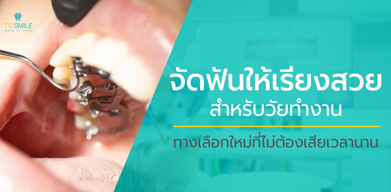 จัดฟันให้เรียงสวยสำหรับวัยทำงาน ทางเลือกใหม่ที่ไม่ต้องเสียเวลานาน