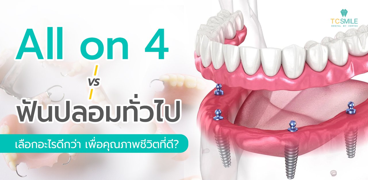 all on 4 VS ฟันปลอมทั่วไป เลือกอะไรดีกว่าเพื่อคุณภาพชีวิตที่ดี